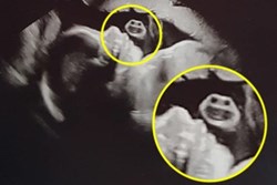 Đang siêu âm, bác sĩ đột nhiên hét lên một tiếng, bà mẹ hoảng hốt phát hiện ra có một khuôn mặt kỳ dị bên cạnh em bé