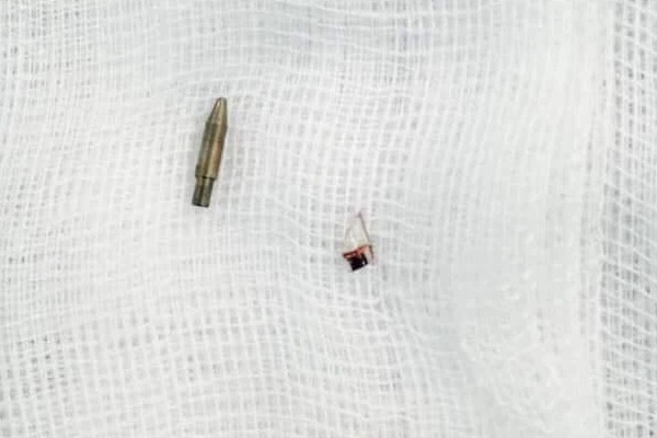 Ngồi phải bút bi bạn để dưới ghế, nam sinh chấn thương vùng kín phải mổ cấp cứu-1