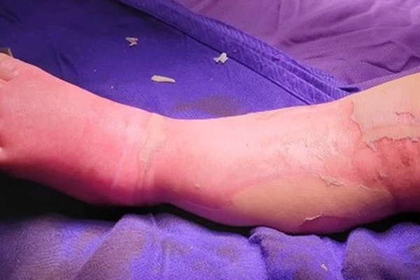 Bé 9 tháng tuổi ở Bắc Giang tử vong vì sốc nhiễm khuẩn, ngừng tuần hoàn do gia đình đắp lá chữa bỏng-2