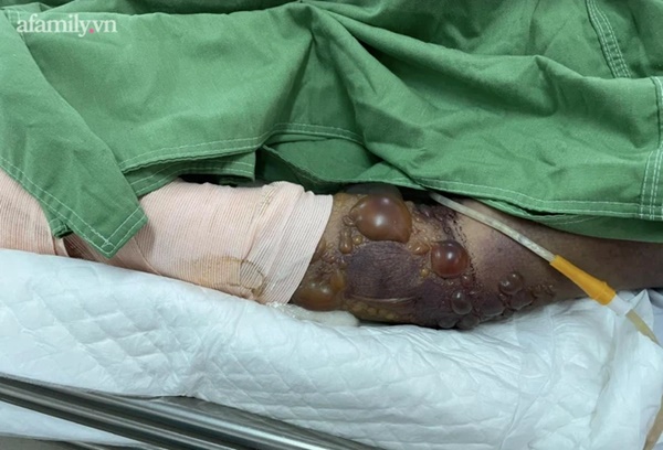 Cứu 2 bệnh nhân ở An Giang bị rắn chàm quạp cắn nguy kịch khi đi cắt lá sả-2