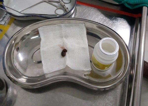 Đỉa vào sống ký sinh trong mũi người đàn ông sau khi uống nước suối-2