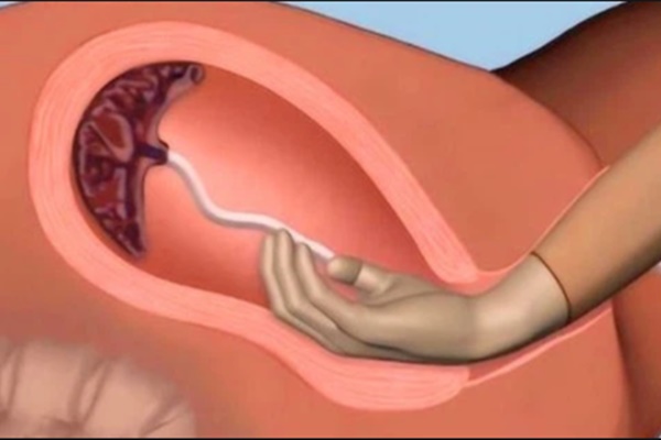 Điều tra loại hạt vi nhựa được tìm thấy trên nhau thai-2