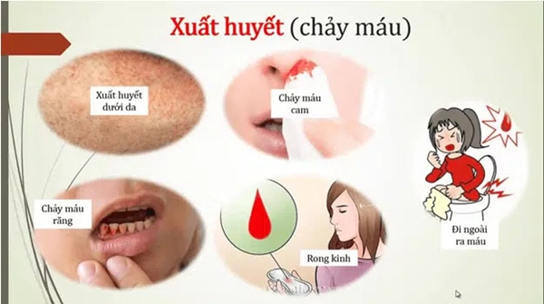 2 trường hợp tử vong do sốt xuất huyết, bất kì ai cũng cần biết những điều nên và không nên làm khi bị sốt xuất huyết-6