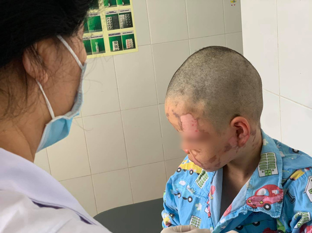 Bé trai 10 tuổi nghịch theo clip trên mạng, tự mua cồn về đốt gây bỏng toàn bộ mặt-1