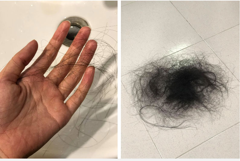 Quá trình xạ trị đầy đau đớn của nữ MC thời tiết mắc ung thư: Phát hiện dấu hiệu bệnh chỉ 10 ngày, từ tóc đến lông mi lông mày đều rụng sạch-10