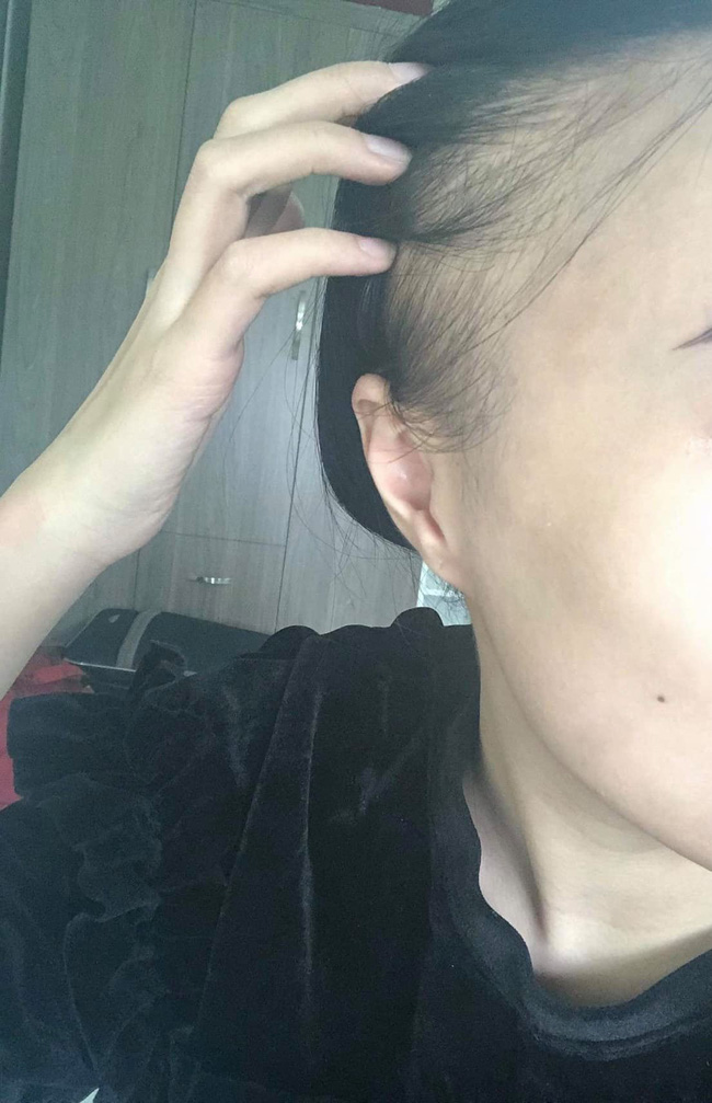 Quá trình xạ trị đầy đau đớn của nữ MC thời tiết mắc ung thư: Phát hiện dấu hiệu bệnh chỉ 10 ngày, từ tóc đến lông mi lông mày đều rụng sạch-11