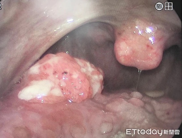 Miệng bốc mùi kéo dài gần nửa năm, người đàn ông đến bệnh viện khám mới biết bị ung thư giai đoạn 2-3