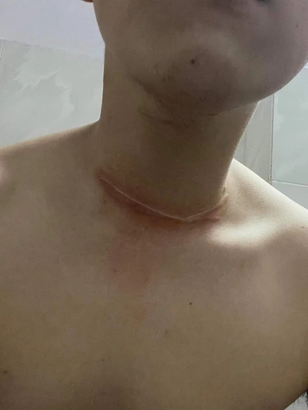 TP.HCM: Nhiều người đi đường liên tục bị dây diều cứa vào cổ, bị thương-3