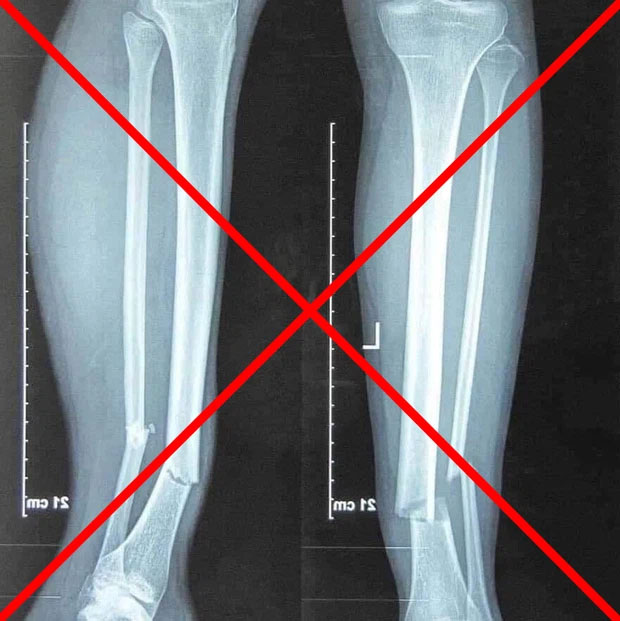 Thực hư ảnh chụp X-quang gãy rời 2 chân gây sốc của Hùng Dũng-1