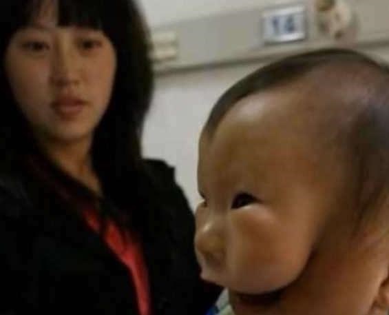 Cậu bé sinh ra với khuôn mặt như đeo mặt nạ, nguyên nhân gây ra dị tật đáng sợ này khiến ai cũng giật mình-1