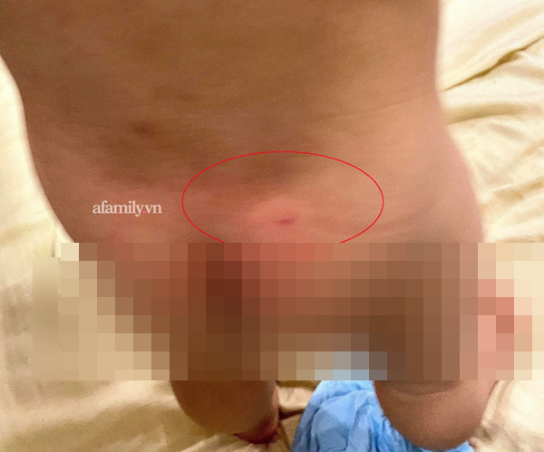 Phụ huynh ở Hà Nội phản ánh con 16 tháng đi học bị cấu và xịt nước nóng, trường đồng ý là vết móng tay người lớn nhưng không có câu trả lời chính xác?-1