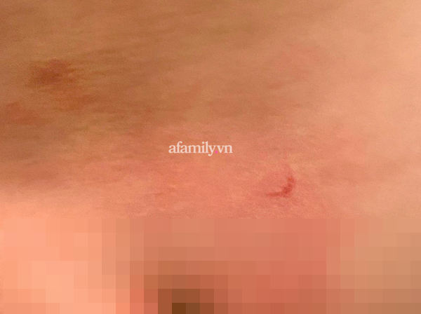 Phụ huynh ở Hà Nội phản ánh con 16 tháng đi học bị cấu và xịt nước nóng, trường đồng ý là vết móng tay người lớn nhưng không có câu trả lời chính xác?-2