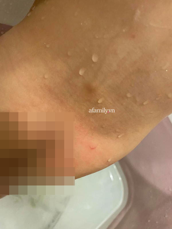 Phụ huynh ở Hà Nội phản ánh con 16 tháng đi học bị cấu và xịt nước nóng, trường đồng ý là vết móng tay người lớn nhưng không có câu trả lời chính xác?-3