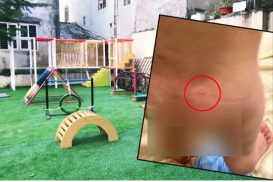 Phụ huynh ở Hà Nội phản ánh con 16 tháng đi học bị cấu và xịt nước nóng, trường đồng ý là vết móng tay người lớn nhưng không có câu trả lời chính xác?