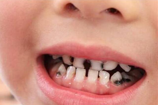 Bé 3 tuổi không bao giờ ăn đường nhưng miệng vẫn đầy răng sâu: Bố mẹ cần lưu ý những vấn đề được nha sĩ chỉ ra-2