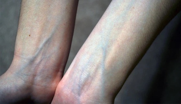 Người có gan xấu sẽ hiển thị rõ 4 vấn đề trên đôi bàn tay, mắc trúng 2 cái thì nên đi khám ngay-2