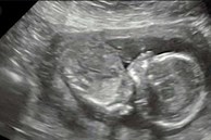 Tin chắc mình đang mang thai cậu bé khổng lồ, nhưng bác sĩ lại thông báo một tin khiến bà mẹ như bị 'sét đánh'