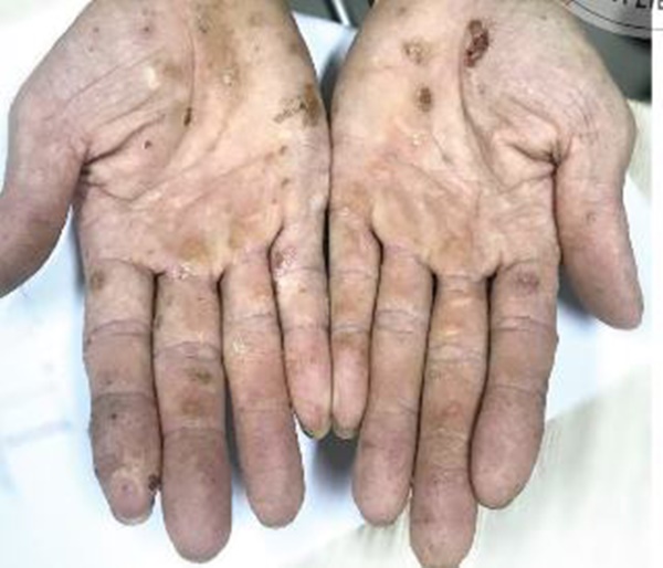 Nhiều người nhiễm độc thạch tín mà không biết-1