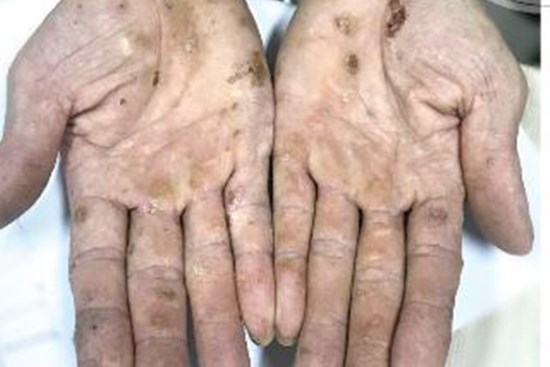 Nhiều người nhiễm độc thạch tín mà không biết