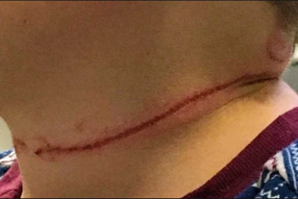 Bị ngã khi đang chơi, bé gái 10 tháng tuổi bị bánh xe ô tô đồ chơi đâm sâu vào trong hộp sọ-5