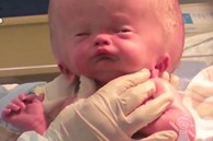 Bé trai sinh ra với căn bệnh não úng thủy, 6 tháng tuổi đã phải lên bàn mổ liên tục, sở hữu dung mạo hiện tại khiến ai cũng trầm trồ