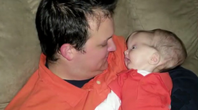 Bé trai sinh ra với căn bệnh não úng thủy, 6 tháng tuổi đã phải lên bàn mổ liên tục, sở hữu dung mạo hiện tại khiến ai cũng trầm trồ-4