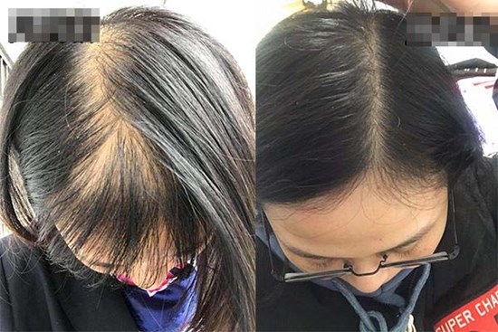 Bé gái xinh xắn bỗng dưng bị hói đầu khi mới học lớp 2, người mẹ tá hỏa khi phát hiện ra “thủ phạm”