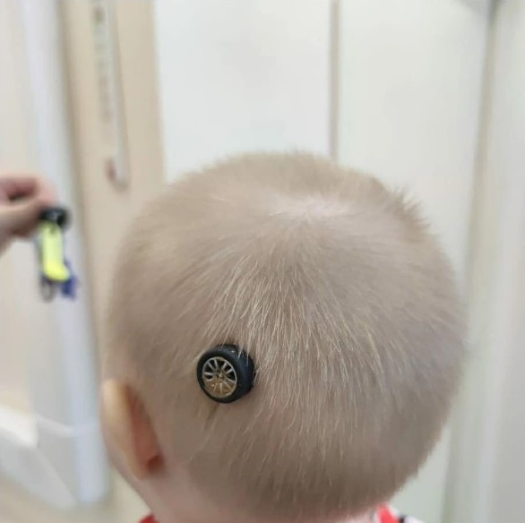 Bị ngã khi đang chơi, bé gái 10 tháng tuổi bị bánh xe ô tô đồ chơi đâm sâu vào trong hộp sọ-1