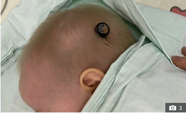 Bị ngã khi đang chơi, bé gái 10 tháng tuổi bị bánh xe ô tô đồ chơi đâm sâu vào trong hộp sọ-2