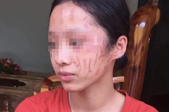 Nữ sinh cào nhau nát mặt, hai gia đình tự giảng hòa