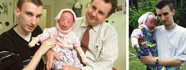 Cô bé từng bỏng nặng đến biến dạng, cứu hoả nhìn cứ ngỡ là búp bê nhựa đen gây bất ngờ với diện mạo và cuộc sống hiện tại-2