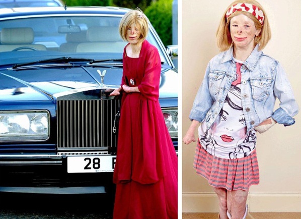 Cô bé từng bỏng nặng đến biến dạng, cứu hoả nhìn cứ ngỡ là búp bê nhựa đen gây bất ngờ với diện mạo và cuộc sống hiện tại-5