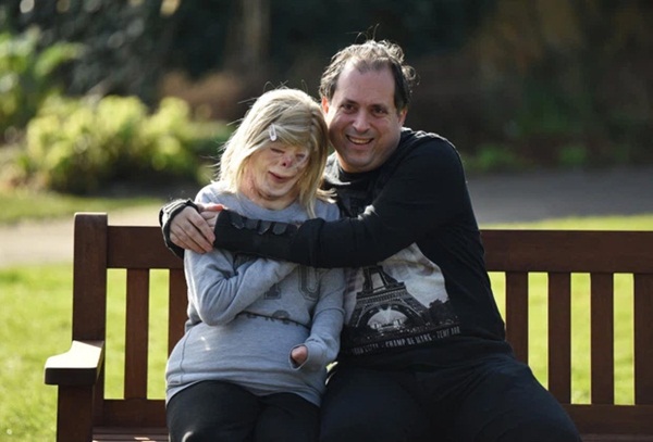 Cô bé từng bỏng nặng đến biến dạng, cứu hoả nhìn cứ ngỡ là búp bê nhựa đen gây bất ngờ với diện mạo và cuộc sống hiện tại-6