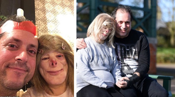 Cô bé từng bỏng nặng đến biến dạng, cứu hoả nhìn cứ ngỡ là búp bê nhựa đen gây bất ngờ với diện mạo và cuộc sống hiện tại-7