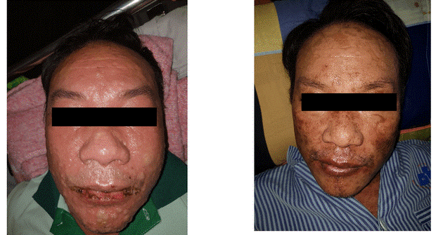 Người trầy da, lở loét, rỉ nước hôi tanh chỉ vì thói quen nhiều người làm hàng ngày-2