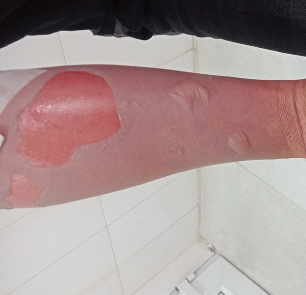 Người trầy da, lở loét, rỉ nước hôi tanh chỉ vì thói quen nhiều người làm hàng ngày-1