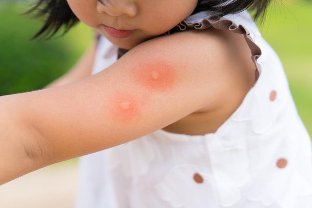 Hóa ra muỗi rất thích cắn những người này, mách bạn thêm cách phòng chống không gây rủi ro-4