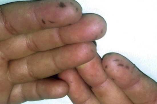 Xuất hiện nhiều đốm tàn nhang ở môi, họng và tay, người phụ nữ không ngờ mình mắc bệnh ung thư