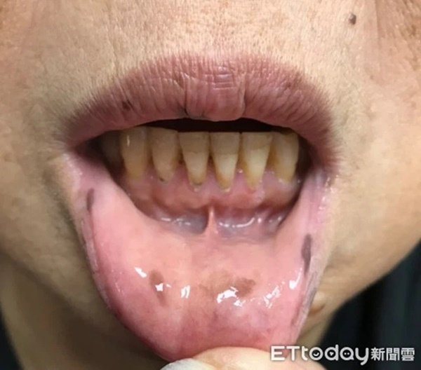 Xuất hiện nhiều đốm tàn nhang ở môi, họng và tay, người phụ nữ không ngờ mình mắc bệnh ung thư-2