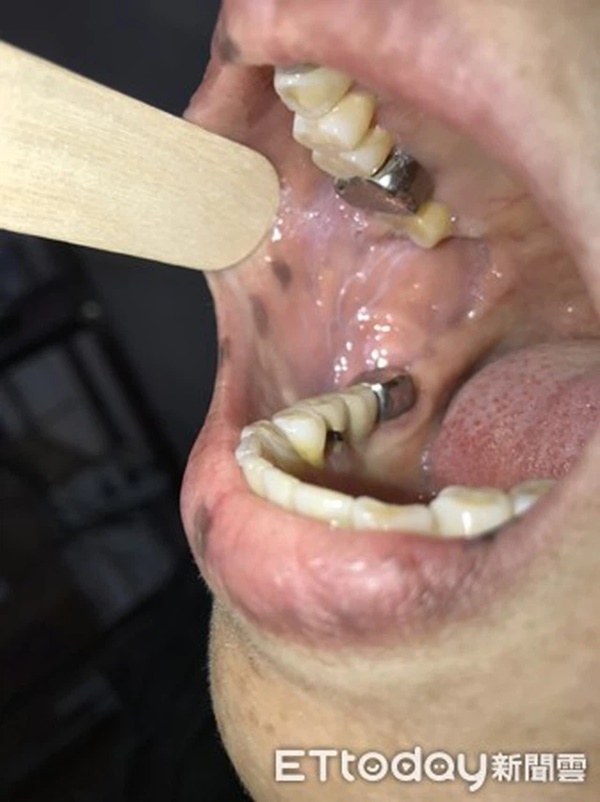 Xuất hiện nhiều đốm tàn nhang ở môi, họng và tay, người phụ nữ không ngờ mình mắc bệnh ung thư-3