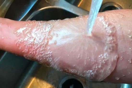 Cháu bị bỏng, bà nội làm điều này, cả nhà đều phản đối nhưng lại được bác sĩ khen ngợi