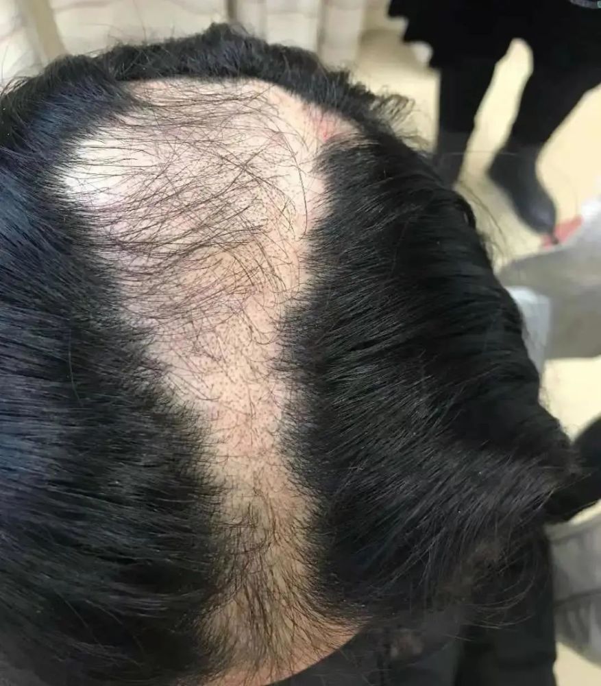 Bé gái 9 tuổi bị rụng tóc nhiều đến mức hói cả mảng, sau khi bác sĩ nói sự thật, bố mẹ gục tại chỗ!-1