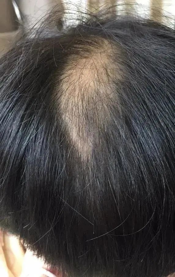 Bé gái 9 tuổi bị rụng tóc nhiều đến mức hói cả mảng, sau khi bác sĩ nói sự thật, bố mẹ gục tại chỗ!-3