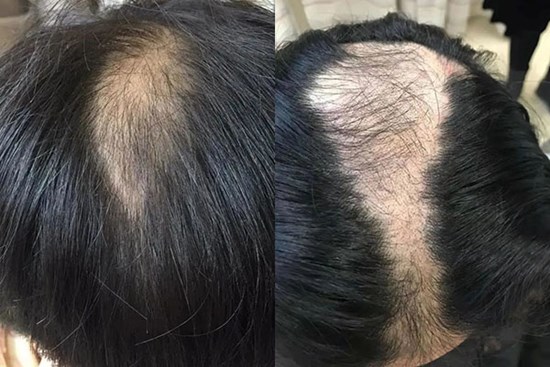 Bé gái 9 tuổi bị rụng tóc nhiều đến mức 