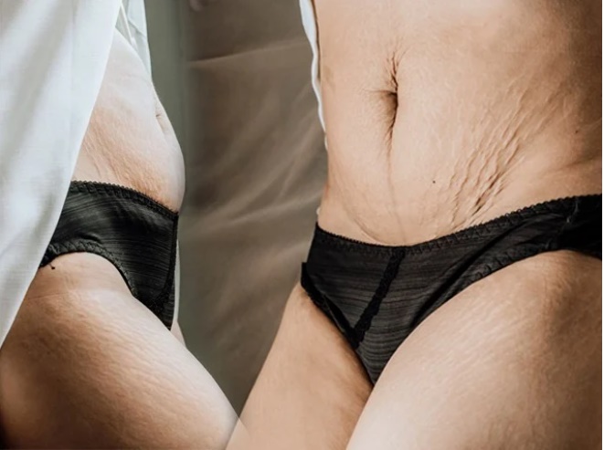 Một số mẹo chữa rạn, chùng da bụng sau sinh cho các bà mẹ tự tin diện bikini ngày hè-1