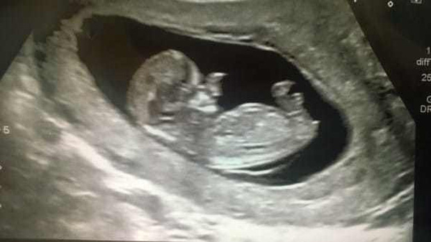 Cậu bé Pinocchio đời thực” sinh ra với chiếc mũi to dị dạng khiến bố mẹ cũng sốc, gây bất ngờ với diện mạo sau ít năm-1