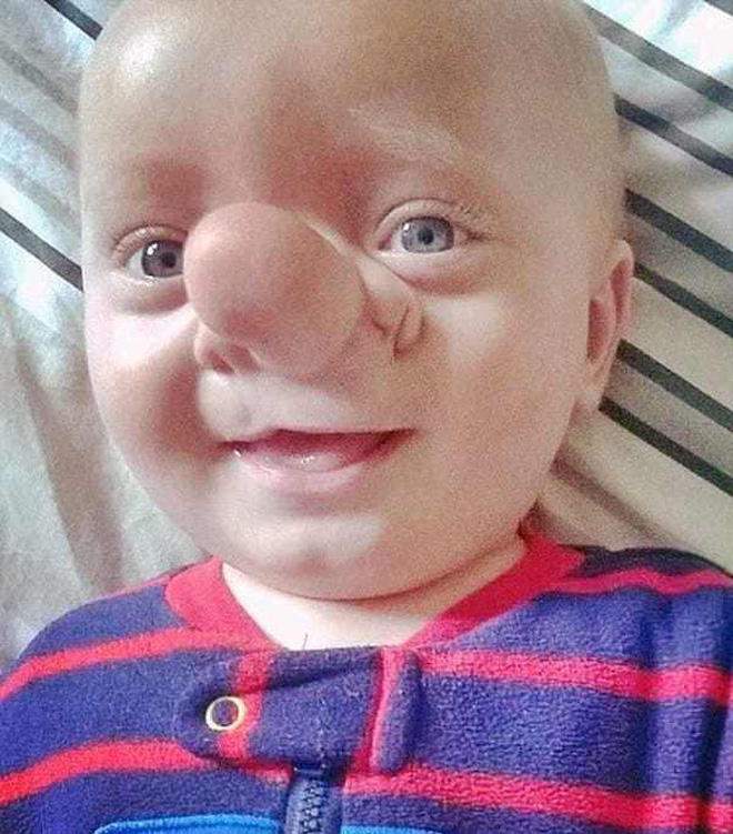 Cậu bé Pinocchio đời thực” sinh ra với chiếc mũi to dị dạng khiến bố mẹ cũng sốc, gây bất ngờ với diện mạo sau ít năm-6