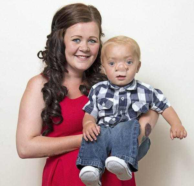 Cậu bé Pinocchio đời thực” sinh ra với chiếc mũi to dị dạng khiến bố mẹ cũng sốc, gây bất ngờ với diện mạo sau ít năm-8