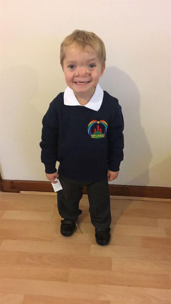 Cậu bé Pinocchio đời thực” sinh ra với chiếc mũi to dị dạng khiến bố mẹ cũng sốc, gây bất ngờ với diện mạo sau ít năm-9