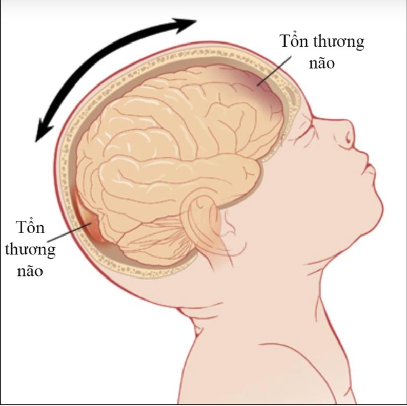 Bé gái 8 tháng tuổi bị bại não vì ông bà nội bế trên tay rung lắc cho cháu ngủ trong một thời gian dài-2